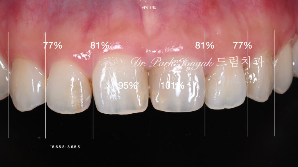 앞니 충치에 대한 라미네이트 치료를 위해 왁스업 정밀진단 진행