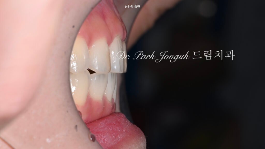 앞니 충치에 대한 라미네이트 치료를 위해 왁스업 정밀진단 진행