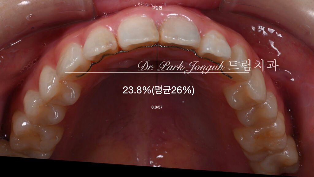 앞니 충치에 대한 라미네이트 치료를 위해 왁스업 정밀진단 진행