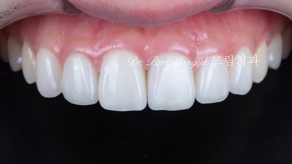 자연스러운 라미네이트