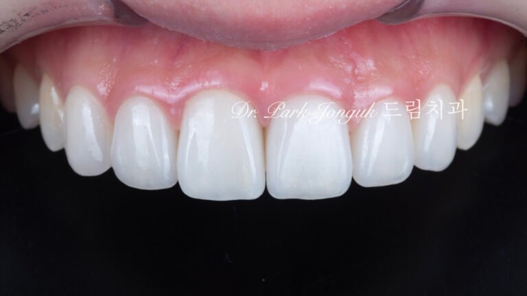 교정 후 앞니 충치에 대한 자연스러운 라미네이트