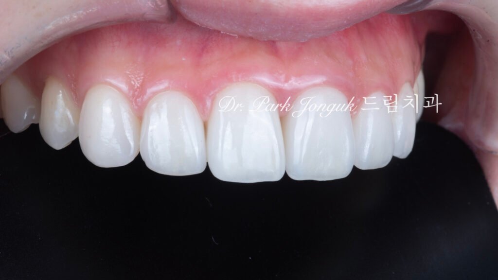 자연스러운 라미네이트