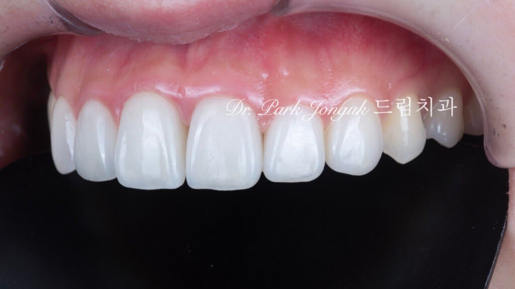 자연스러운 라미네이트