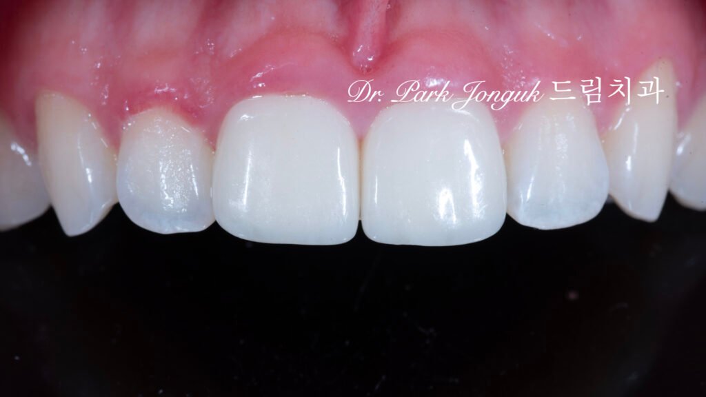 어색하고 인공적인 라미네이트의 재시술을 위해서 내원