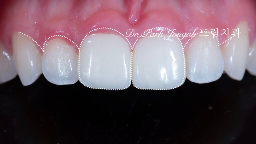 라미네이트 재시술을 위한 진단