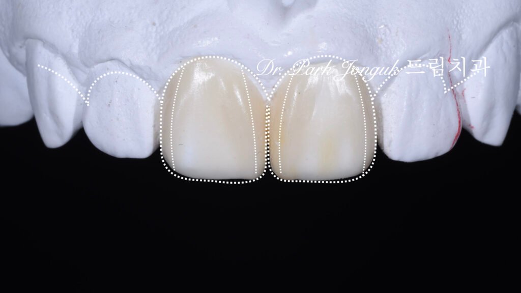 라미네이트 재시술을 위한 진단