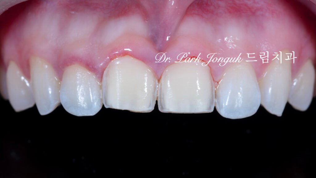 레이저를 이용해서 라미네이트를 안전하게 제거