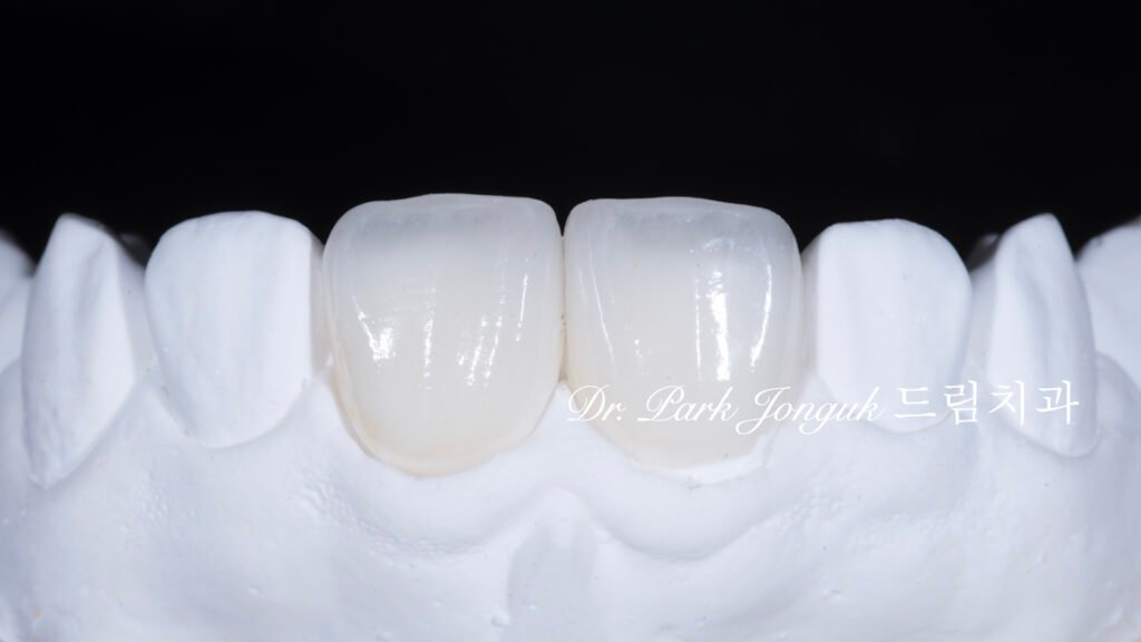 자연스럽고 아름다운 라미네이트 제작