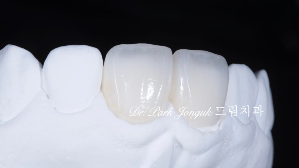 자연스럽고 아름다운 라미네이트 제작