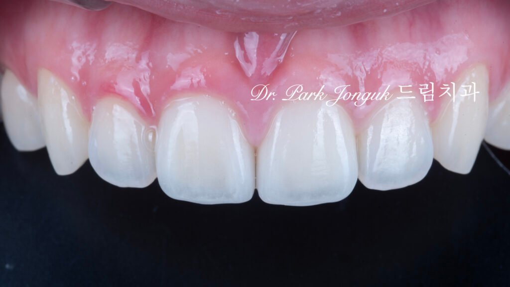 자연스럽고 아름답게 라미네이트 재시술