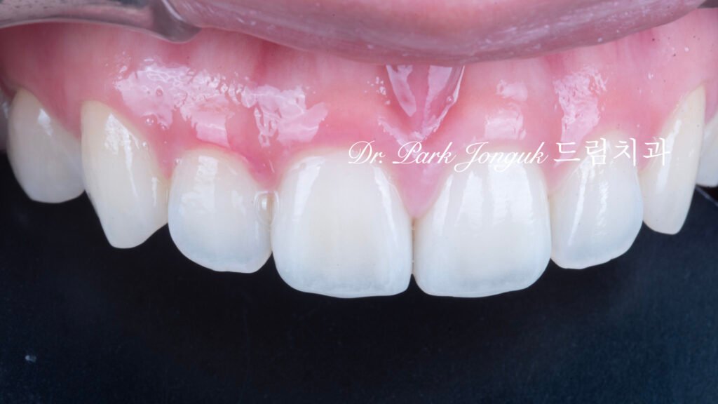 자연스럽고 아름답게 라미네이트 재시술