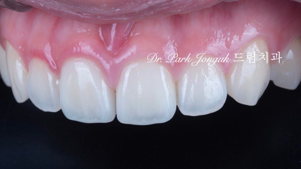 자연스럽고 아름답게 라미네이트 재시술