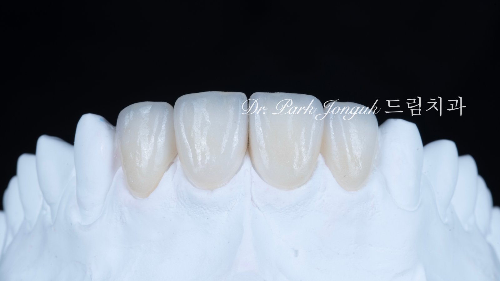 샌드위치 테크닉 무삭제 라미네이트