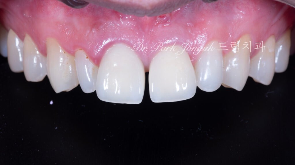 PFM 크라운과 왜소치 상태로 내원