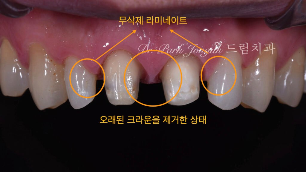 PFM 저게한 상태