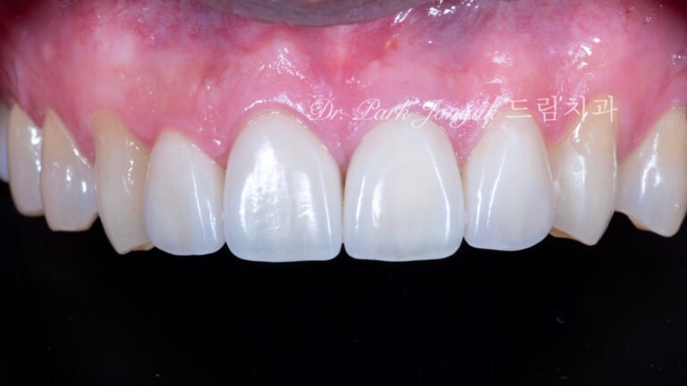 자연스로운 올세라믹 크라운 재시술과 왜소치에 대한 무삭제 라미네이트