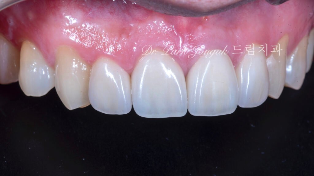 자연스로운 올세라믹 크라운 재시술과 왜소치에 대한 무삭제 라미네이트