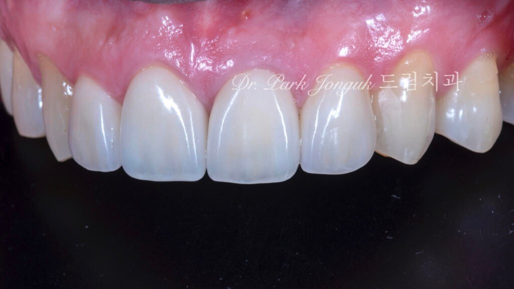 자연스로운 올세라믹 크라운 재시술과 왜소치에 대한 무삭제 라미네이트