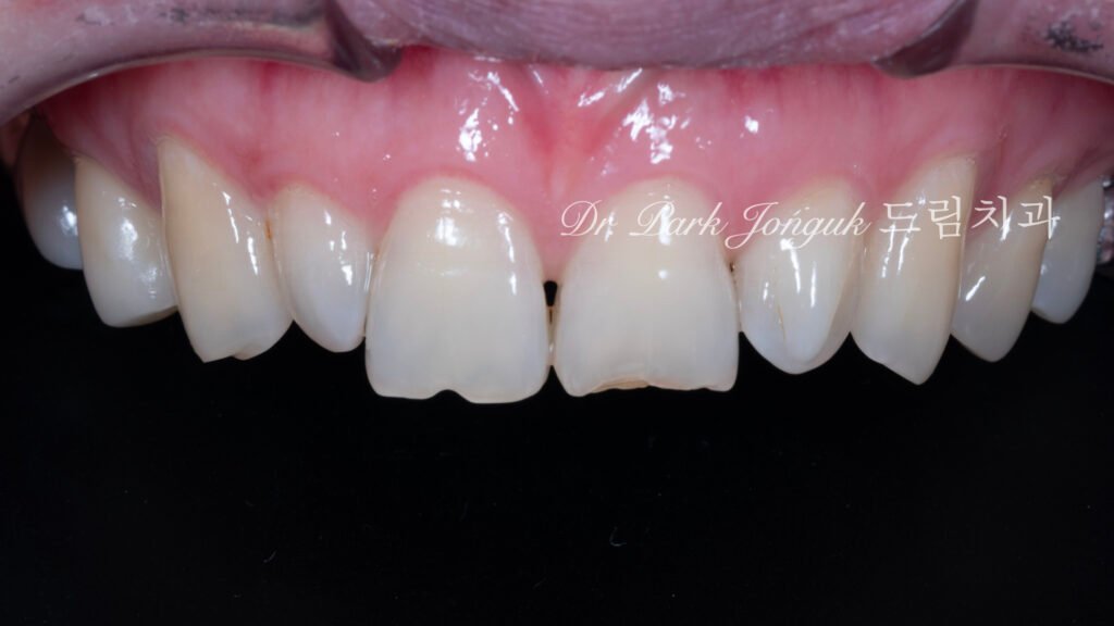 왜소치 기형치로 라미네이트 치료를 위해 내원