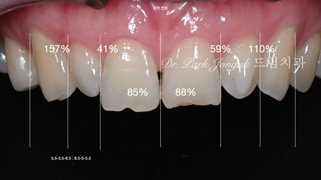 왜소치 기형치로 라미네이트 치료를 위해 내원