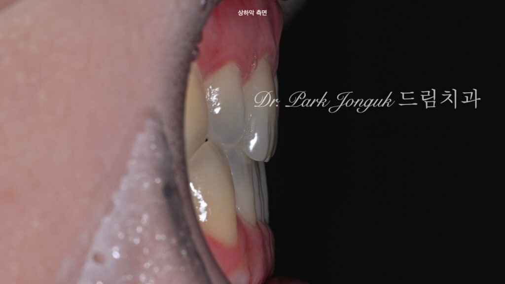 왜소치 기형치로 라미네이트 치료를 위해 내원