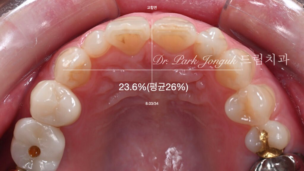 왜소치 기형치로 라미네이트 치료를 위해 내원