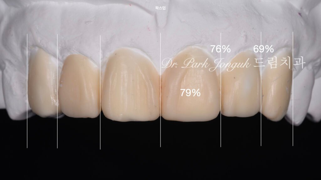 왜소치 기형치로 라미네이트 치료를 위해 내원