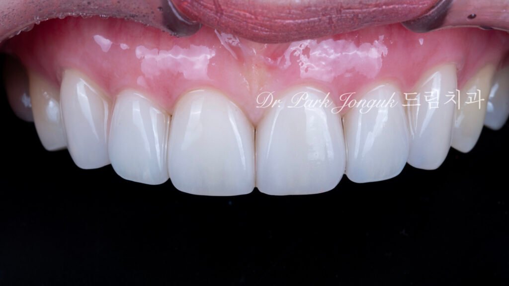 자연스럽고 아름다운 라미네이트