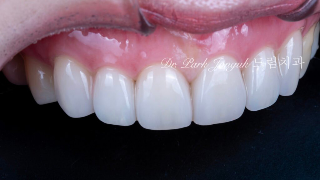 자연스럽고 아름다운 라미네이트