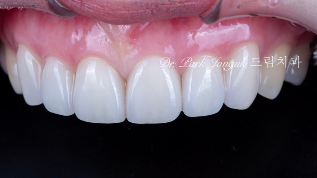 자연스럽고 아름다운 라미네이트