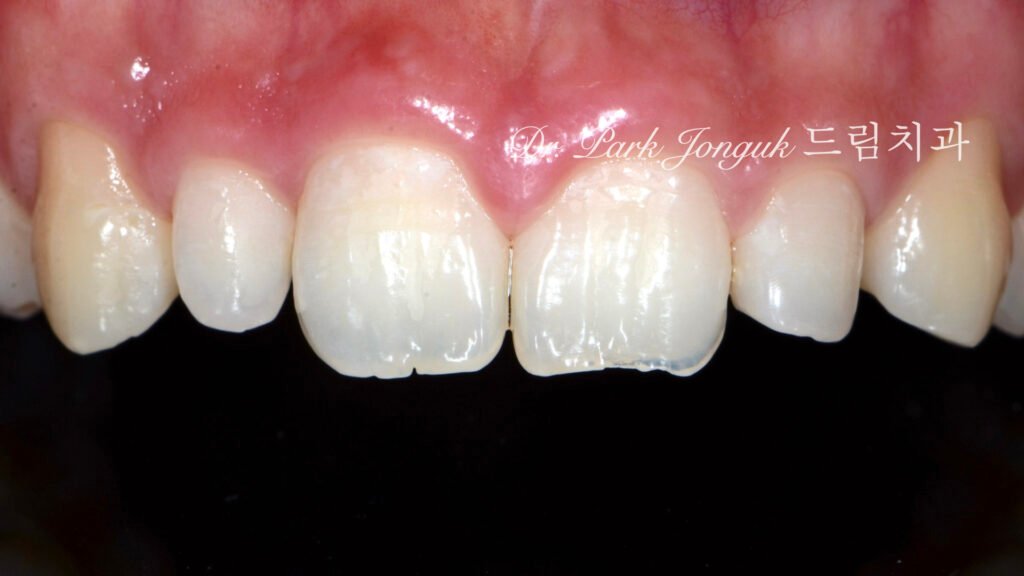 자연스러운 라미네이트 치료를 위해 내원