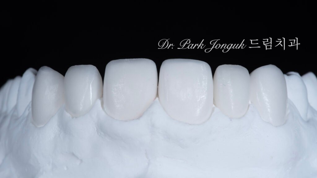 자연스러운 라미네이트를 위한 핸드메이드 빌드업 제작 과정