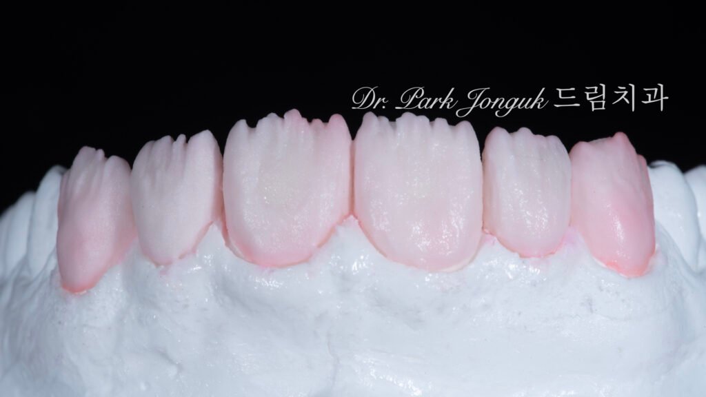 자연스러운 라미네이트를 위한 핸드메이드 빌드업 제작 과정