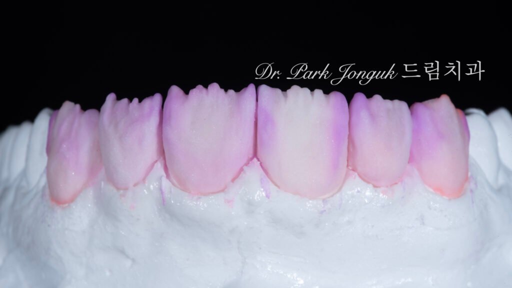 자연스러운 라미네이트를 위한 핸드메이드 빌드업 제작 과정