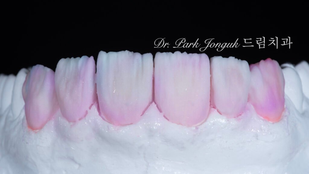 자연스러운 라미네이트를 위한 핸드메이드 빌드업 제작 과정