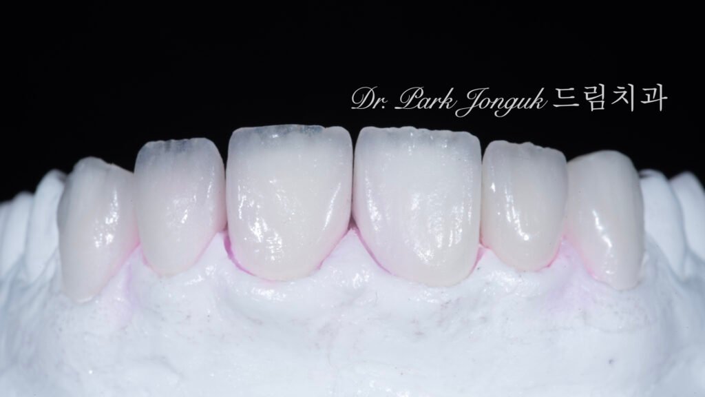 자연스러운 라미네이트를 위한 핸드메이드 빌드업 제작 과정