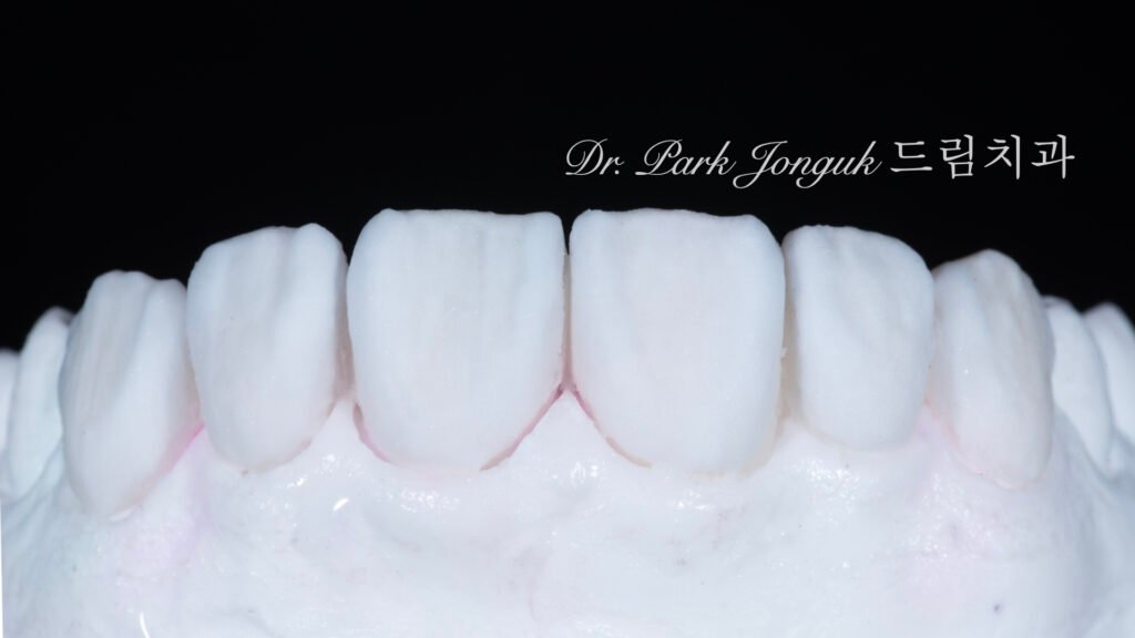 자연스러운 라미네이트를 위한 핸드메이드 빌드업 제작 과정