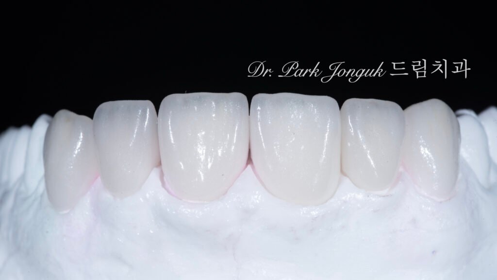 자연스러운 라미네이트를 위한 핸드메이드 빌드업 제작 과정