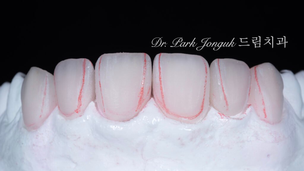 자연스러운 라미네이트를 위한 핸드메이드 빌드업 제작 과정