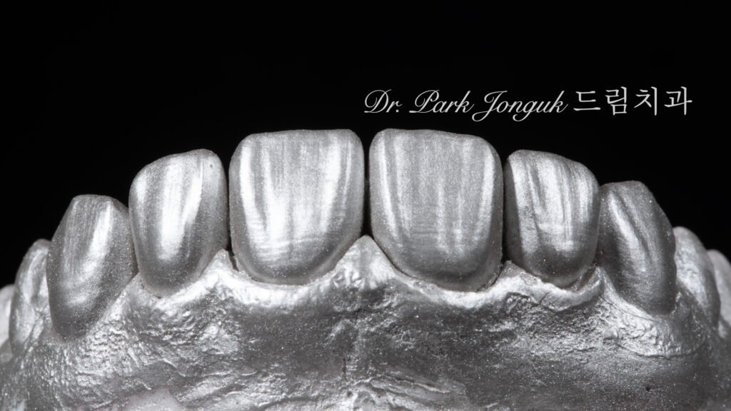 자연스러운 라미네이트를 위한 핸드메이드 빌드업 제작 과정