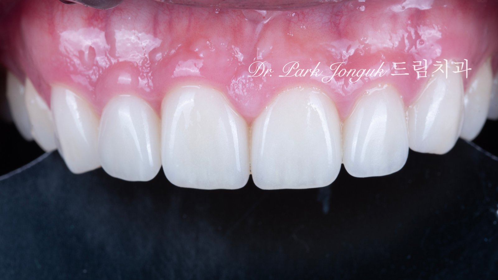 자연스러운 라미네이트