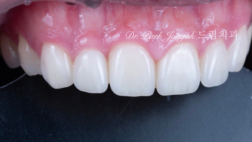 자연스러운 라미네이트