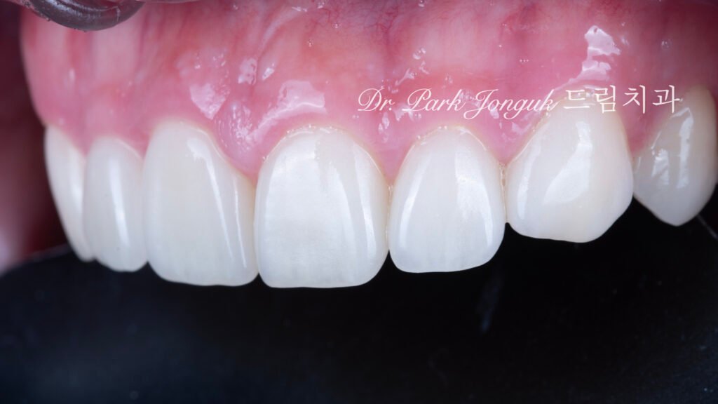 자연스러운 라미네이트