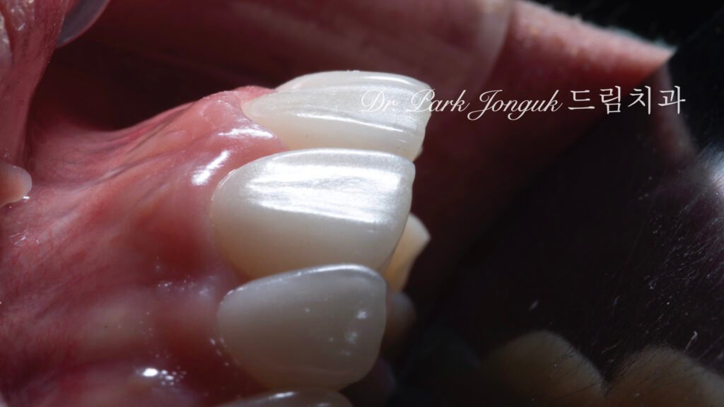 자연스러운 라미네이트