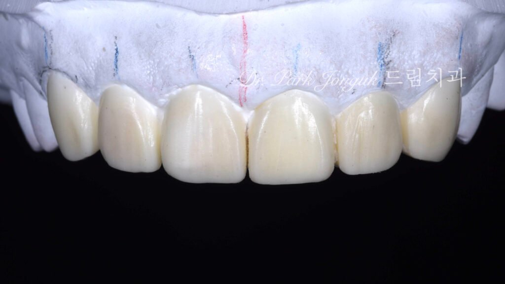 라미네이트를 위한 정밀진단