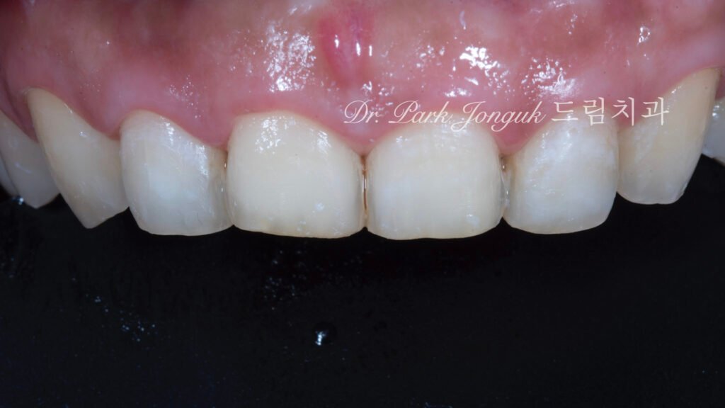 라미네이트를 위한 미세삭제