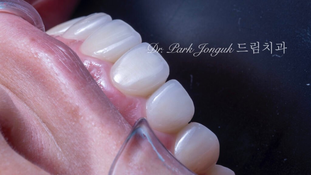 자연스럽고 아름다운 미세삭제 무삭제 라미네이트