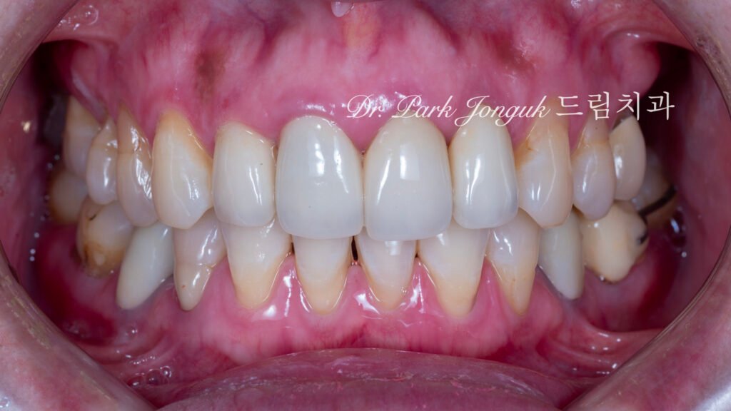 자연스러운 라미네이트