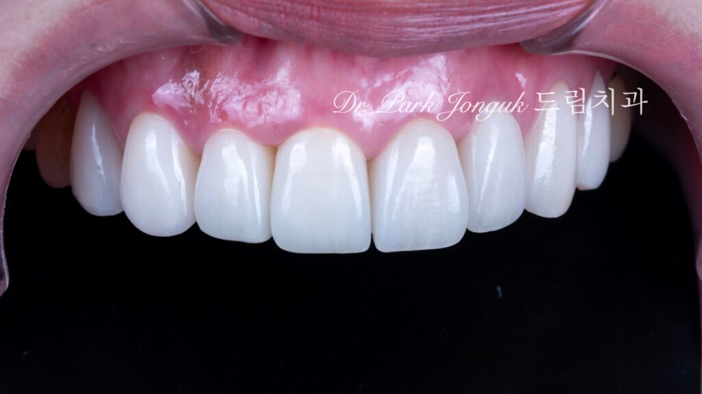 자연스러운 라미네이트