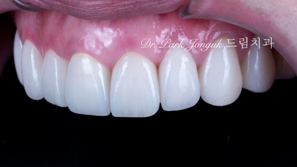 자연스러운 라미네이트